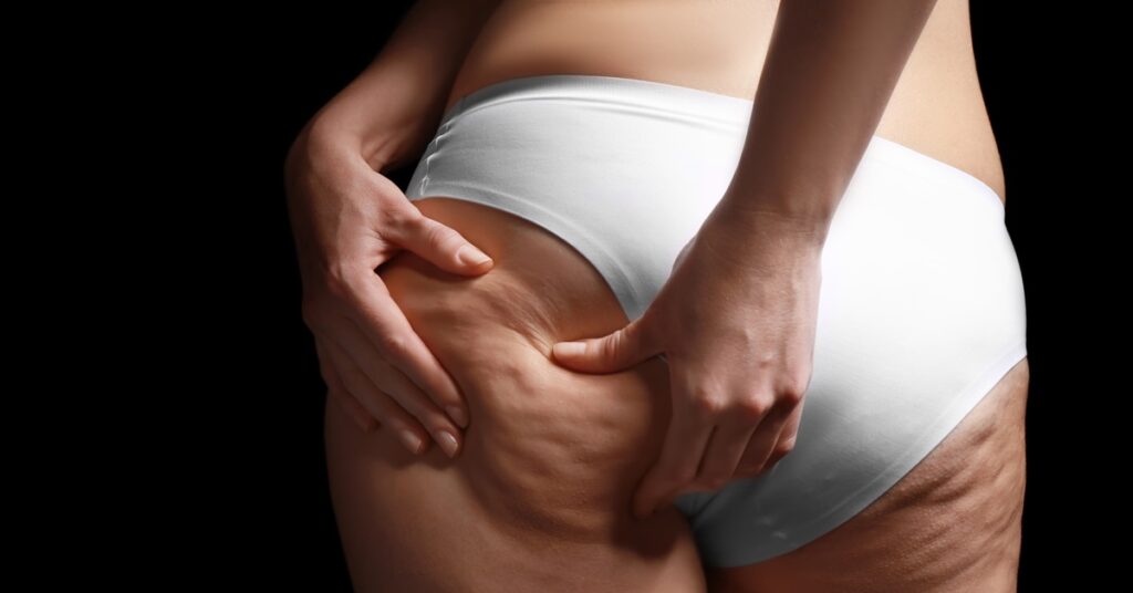 Cellulitisz elleni program 8 lépésben