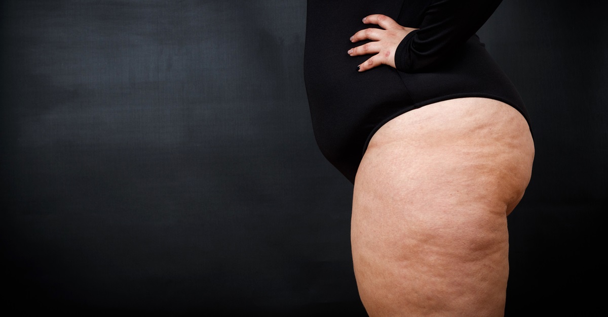 Cellulitisz elleni program 8 lépésben